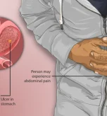 Gastric Ulcer Diet Plan for Better Health
